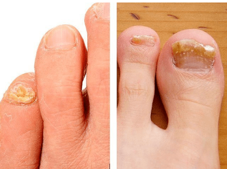 Hongo de uñas