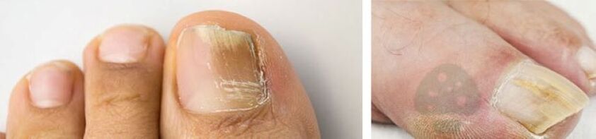 El hongo de la uña del pulgar en la pierna