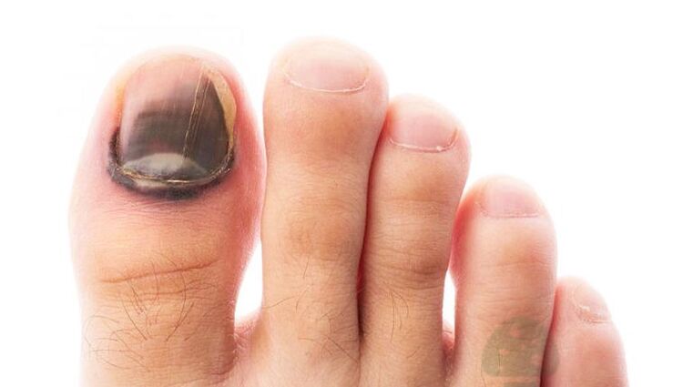 El nivel de funcionamiento de la enfermedad con un hongo del pulgar Sagel